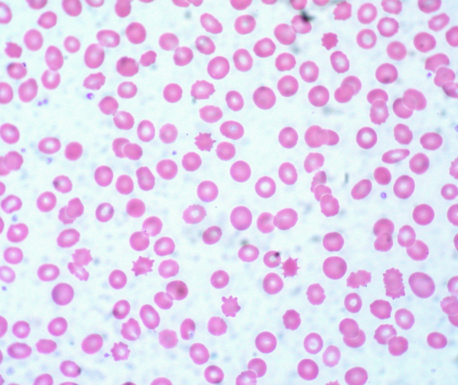 Acanthocytes,_Peripheral_Blood_(3884092551)